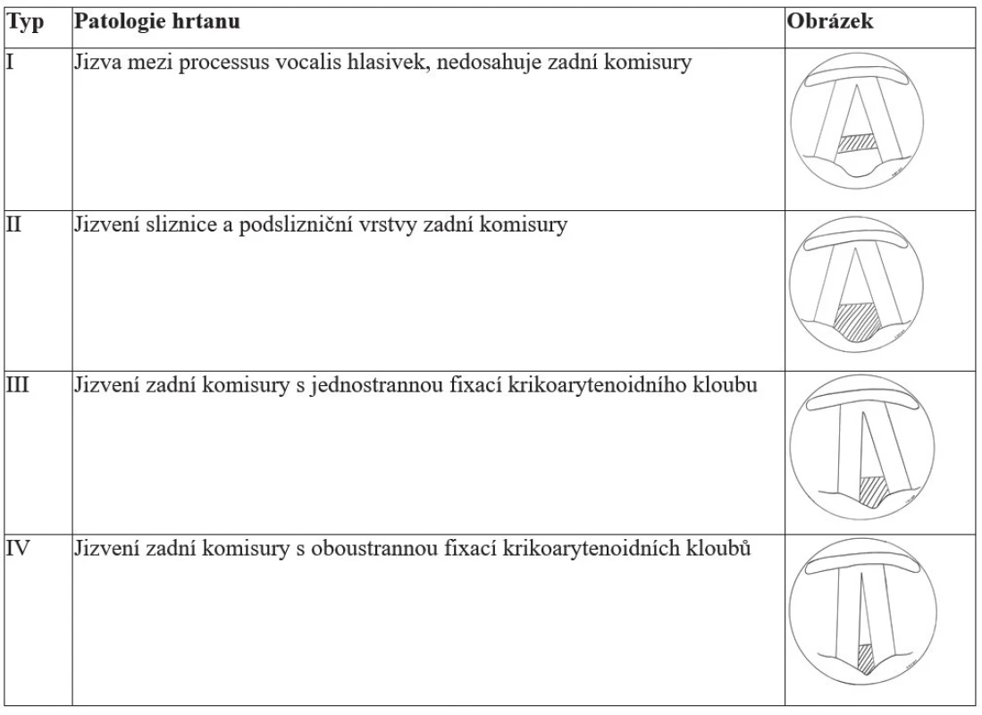Klasifikace zadní glotické stenózy (dle Bogdasariana a Olsena).