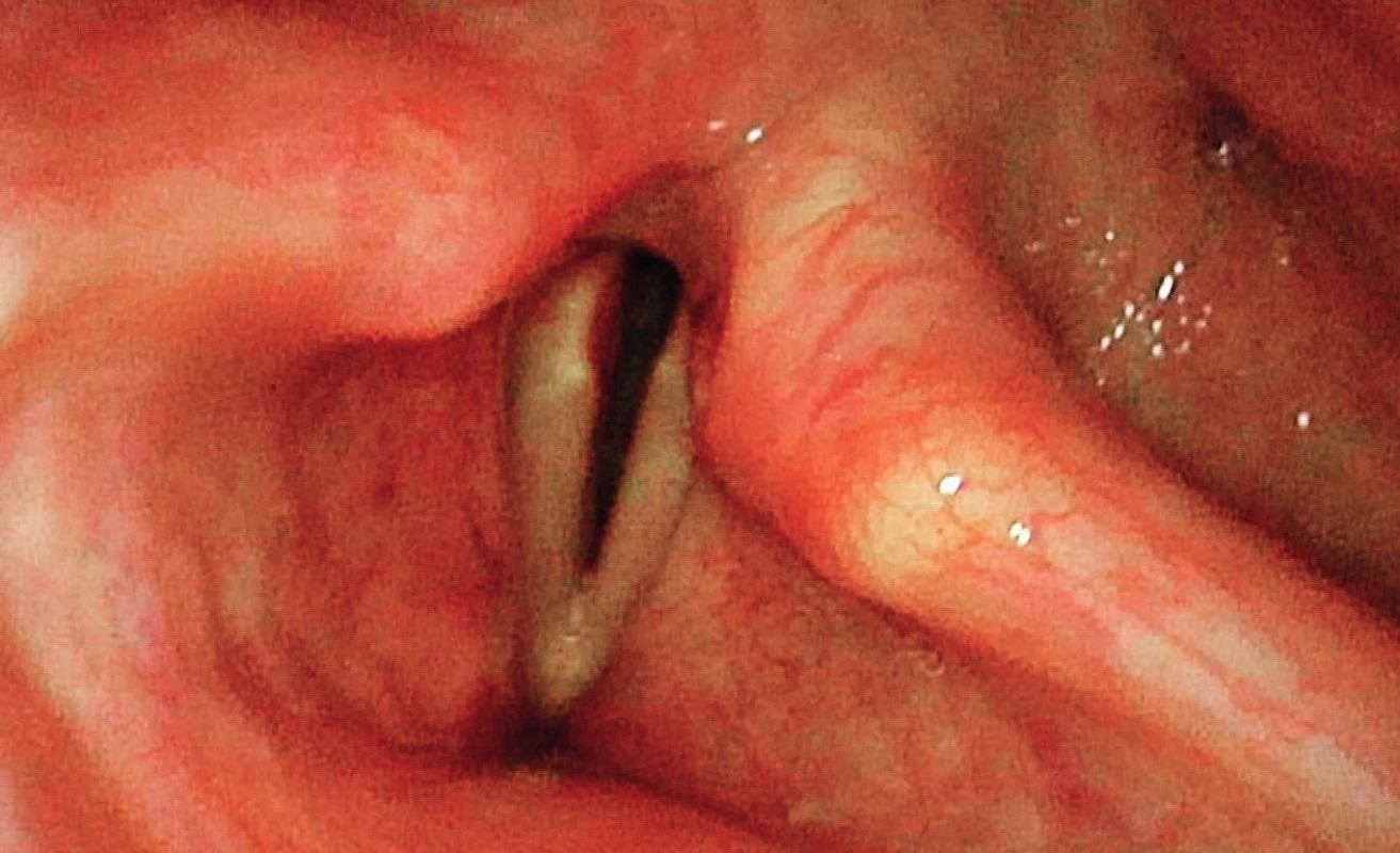 Laryngoskopický obraz před operací, oboustranně hlasivky
v paramediálním postavení, zjizvení zadní komisury.