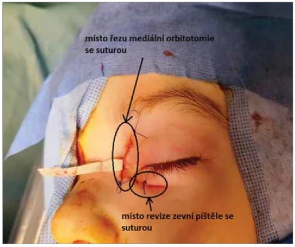 Pacient po výkonu (mediální orbitotomie a revize oblasti vpichu). <br> 
Fig. 4. Patient after the operation (medial orbitotomy and revision of the injection
area).
