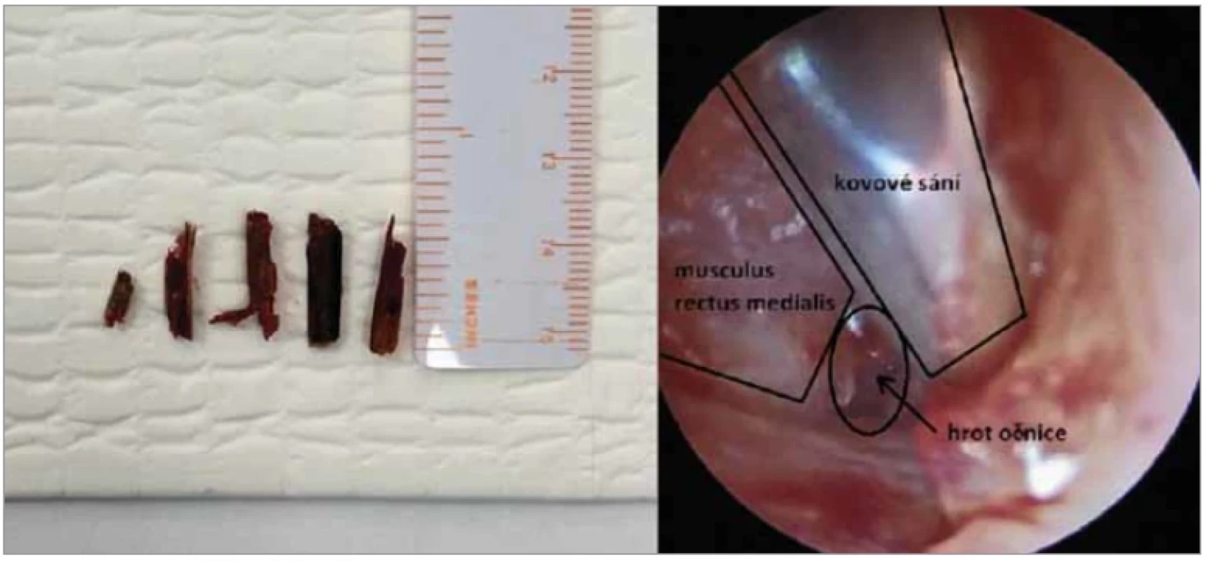 Vlevo – dřevnaté cizí těleso po odstranění, vpravo – peroperační endoskopický pohled do očnice. <br> 
Fig. 3. Left – woody foreign body after removal, right – perioperative endoscopic view of the orbit.